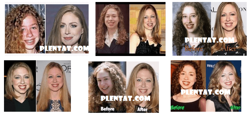 Chelsea Clinton Plastic Surgery Before And After