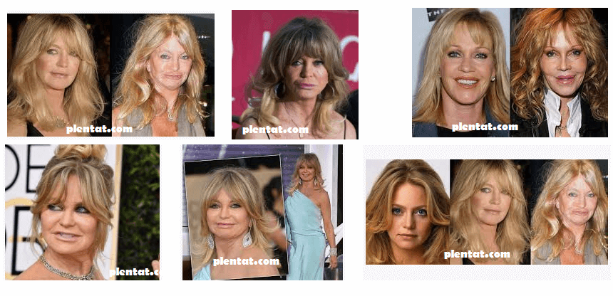 Goldie Hawn Plastic Surgery