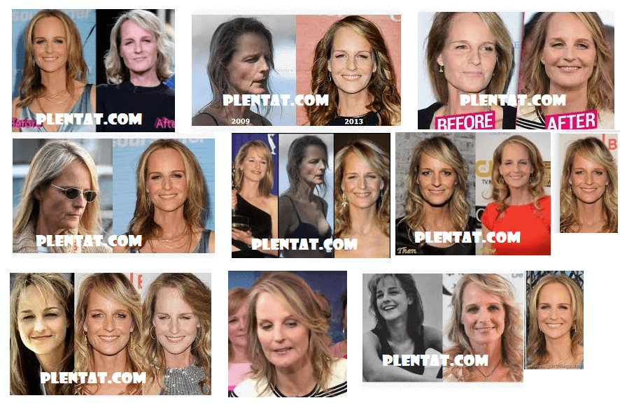 Helen Hunt Plastic Surgery Before And After (1)