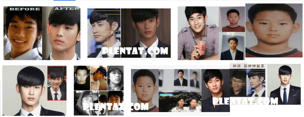 Kim Soo Hyun Plastic Surgery Before And After