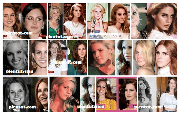 Lana Del Rey Plastic Surgery Before And After