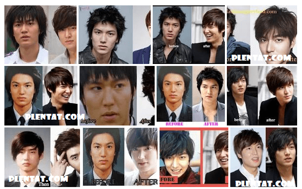 Lee Min Ho Before Plastic Surgery And After