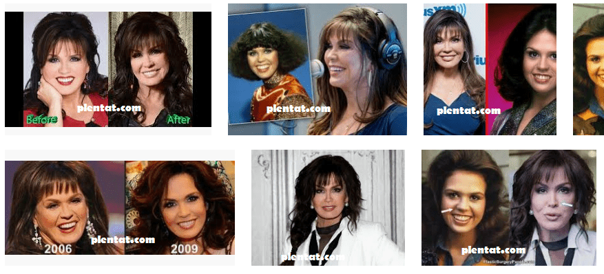 Marie Osmond Plastic Surgery Before And After