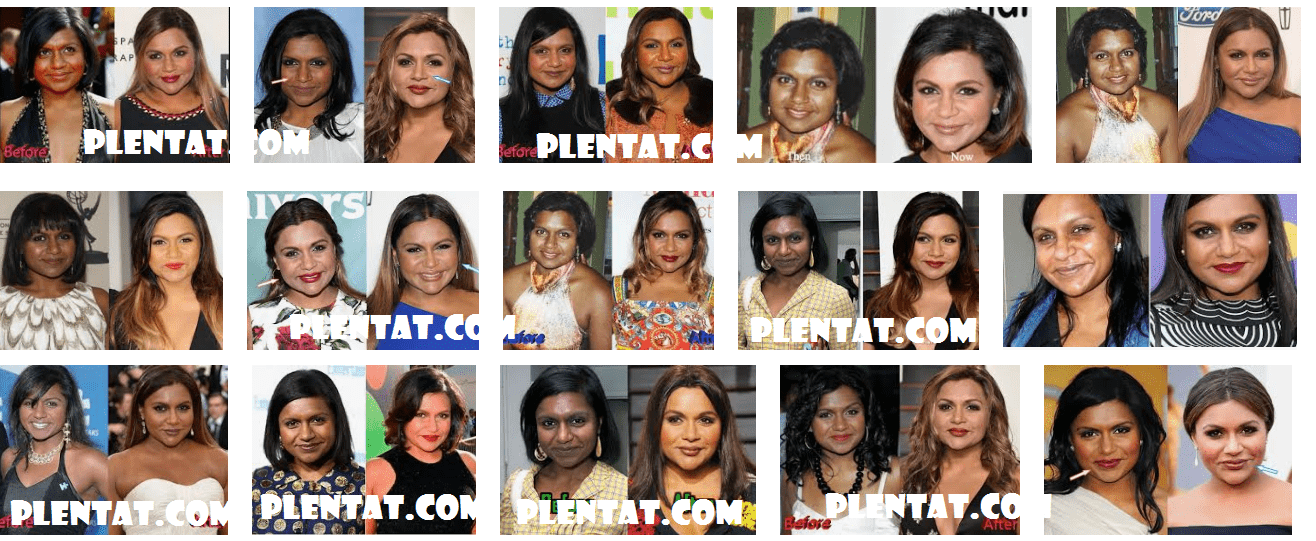 Mindy Kaling Plastic Surgery Before And After