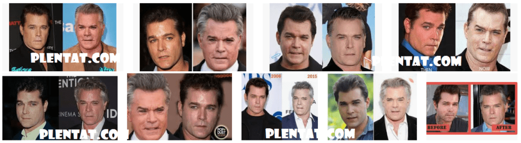 Ray Liotta Plastic Surgery Before And After