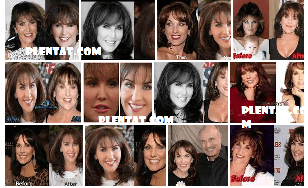 Robin Mcgraw Plastic Surgery Before And After